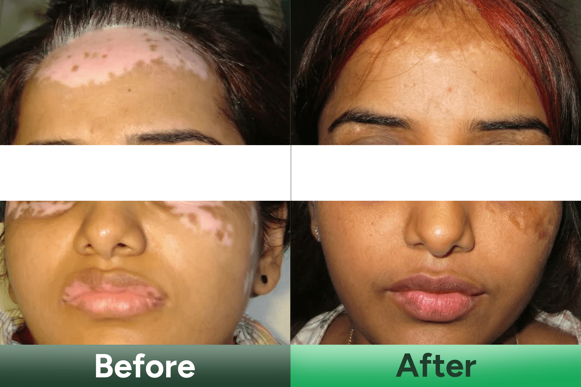 vitiligo care kit