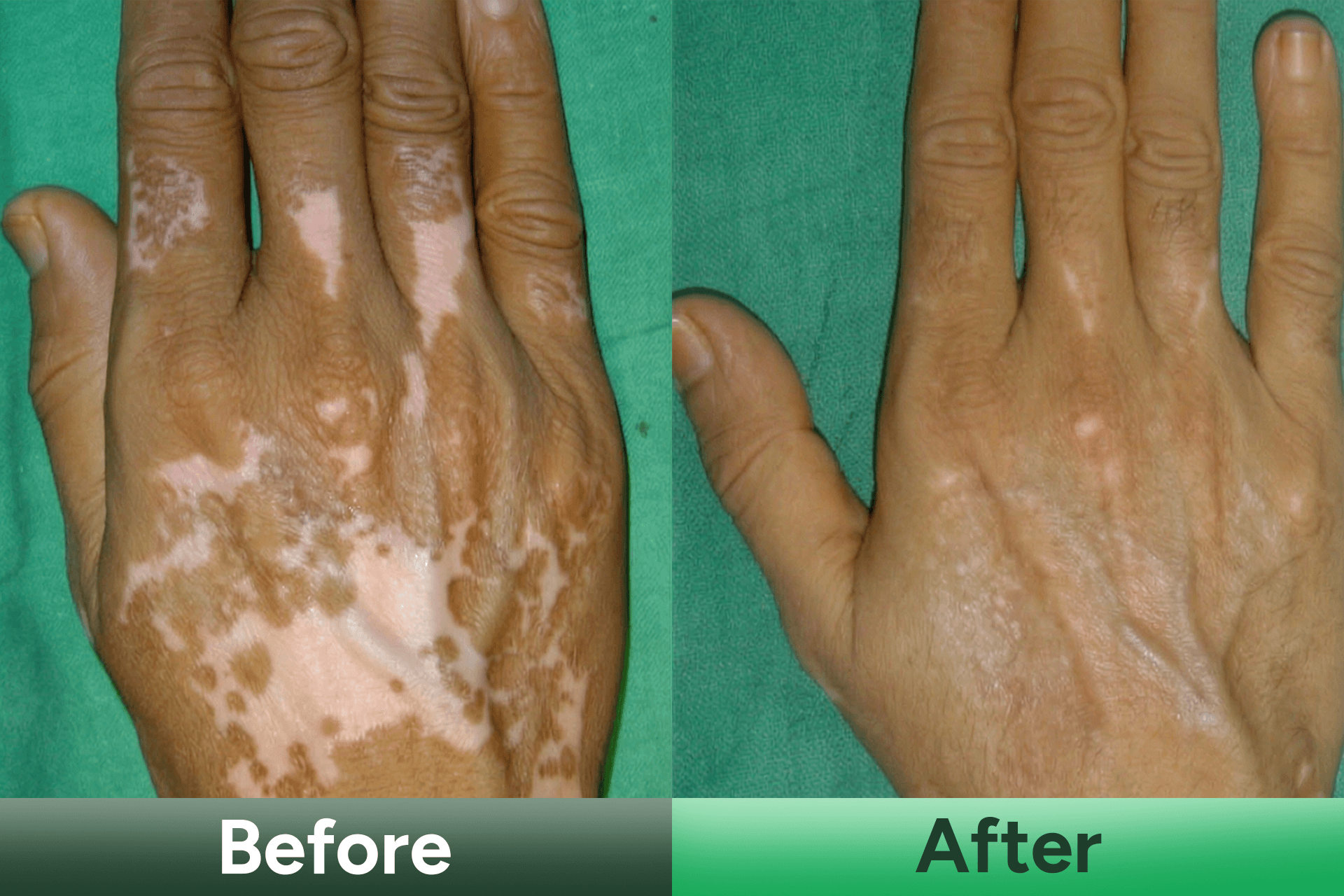 vitiligo kit after before