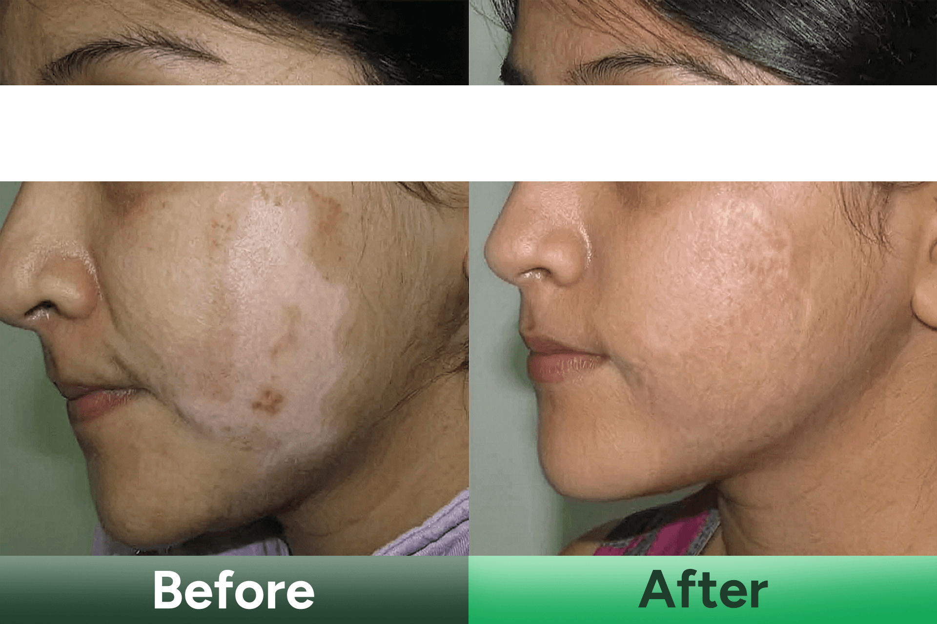 vitiligo care after